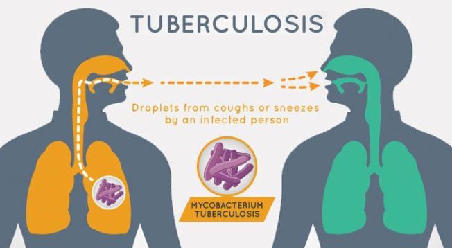 Top 5 Tuberculosis Hospitals – UK’s Choice