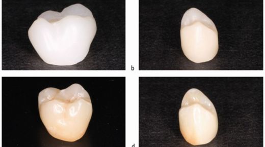 Silane Magic for Dental Bonding Breaking New Ground in Restorations