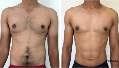 Gynaecomastia in bangalore