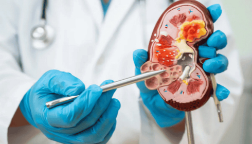 best kidney transplant hospital in Bangalore