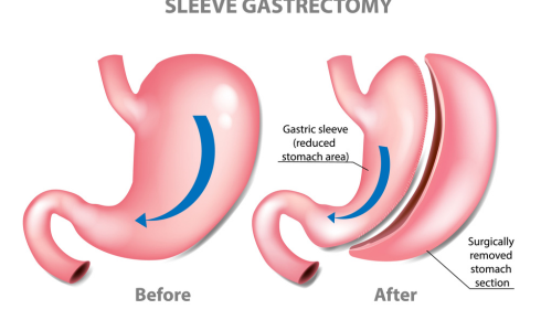 Sleeve Gastrectomy Treatment In Hyderabad